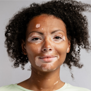 Vitiligo Patches